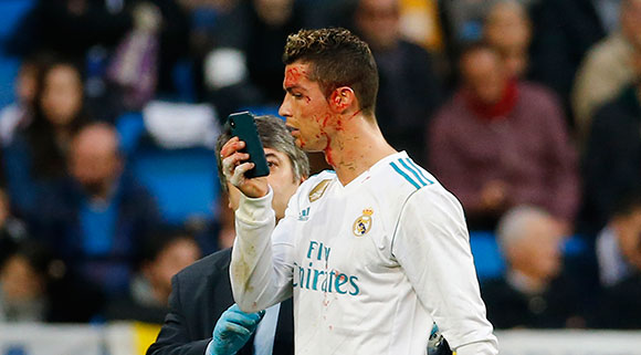 Cristiano Ronaldo liep bij de 6-1 een flinke hoofdwond op. 